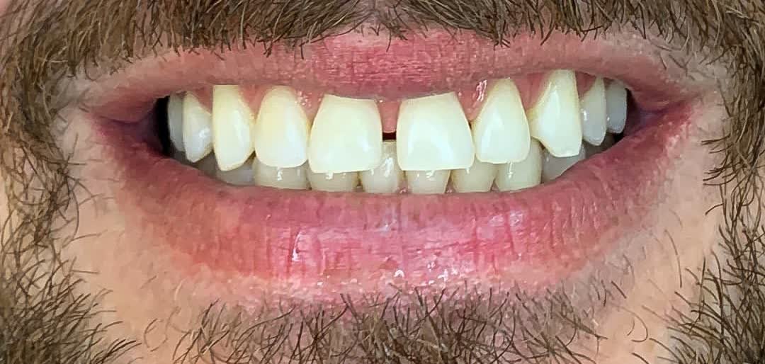 Depois do clareamento dental