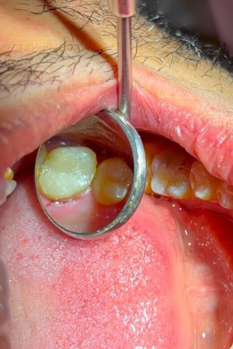 Depois da restauração dental