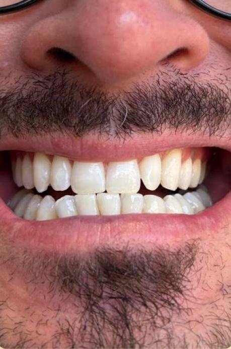 Depois do clareamento dental