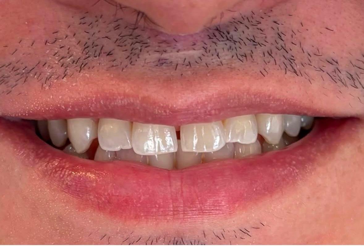 Depois do clareamento dental